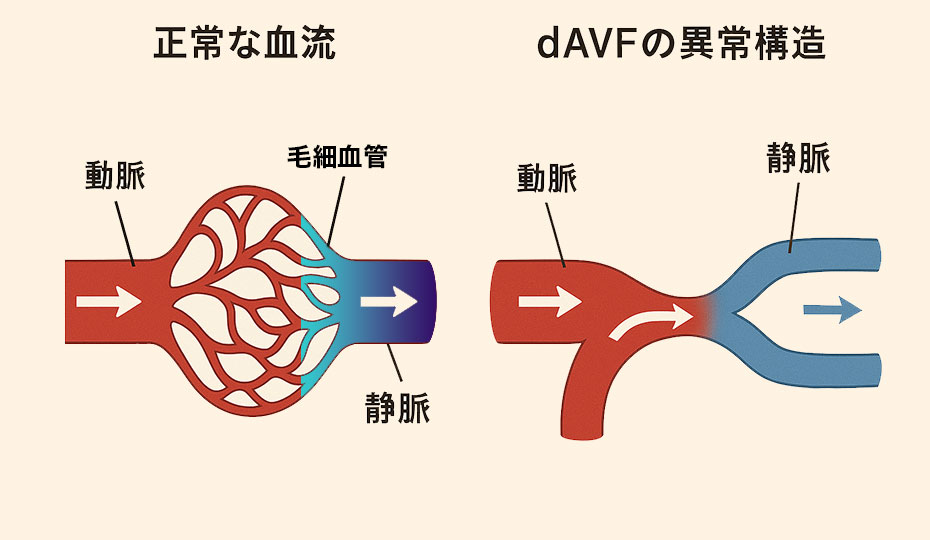 硬膜動静脈瘻と正常な血管構造の違い