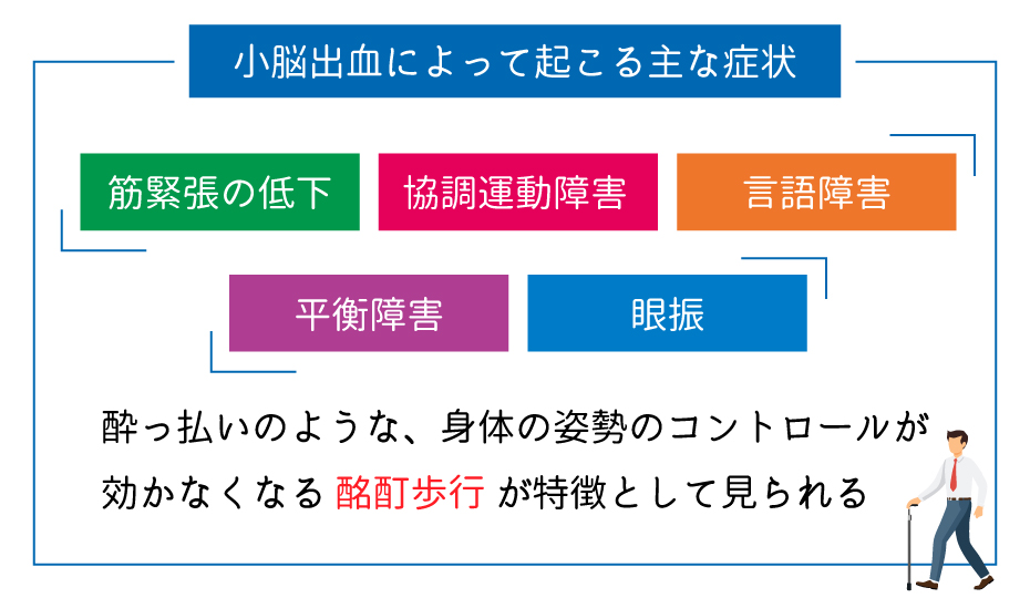 小脳出血によって起こる主な症状
